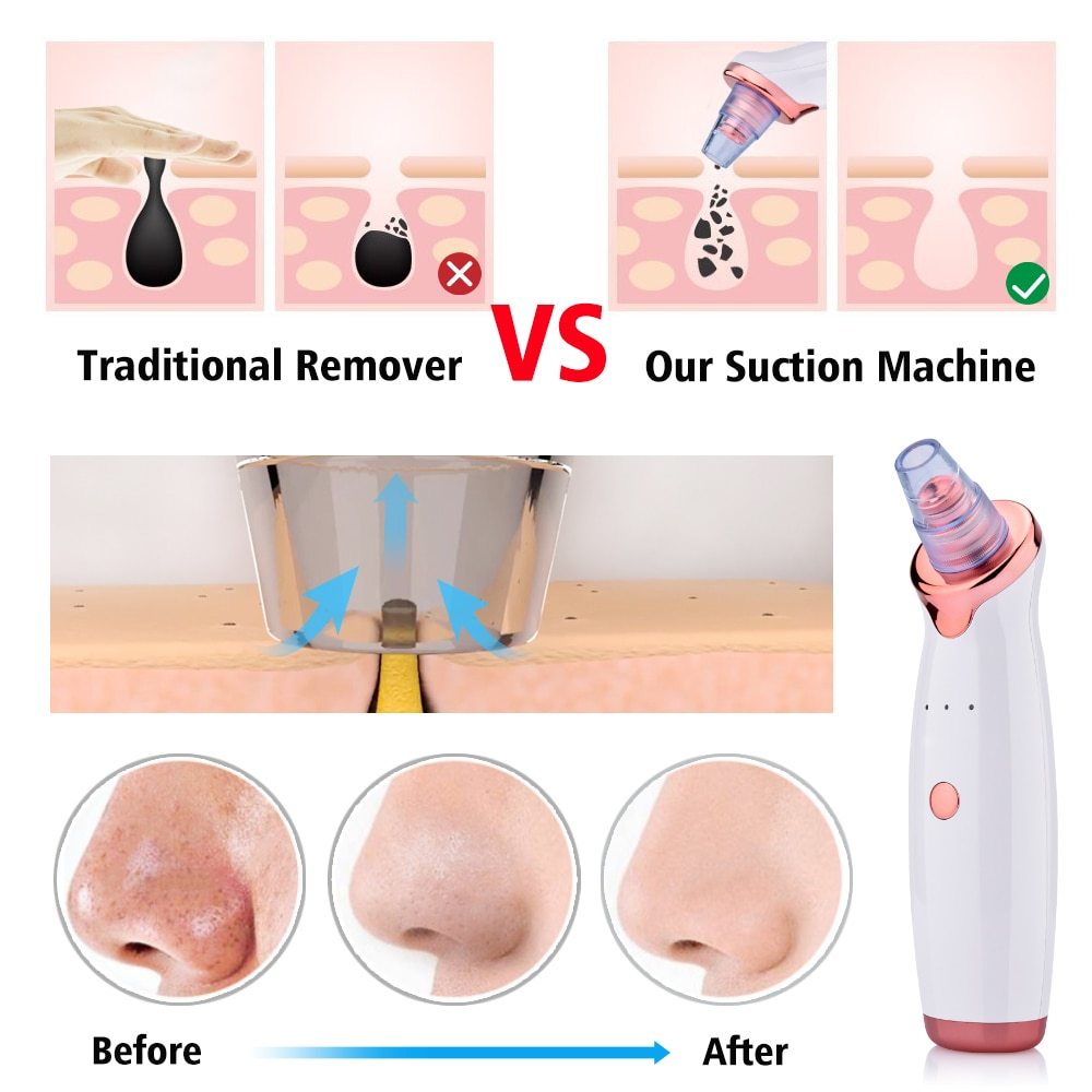Blackhead Electric™ Suction Facial